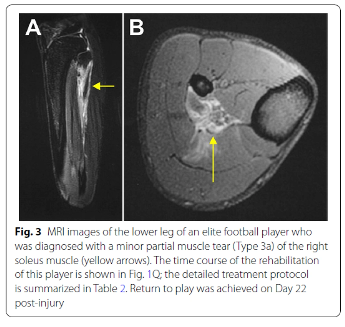 Return to competition after radial extracorporeal shockwave therapy